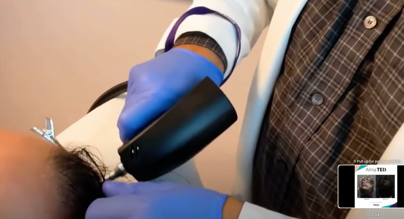 Alma Ted-How does it work?