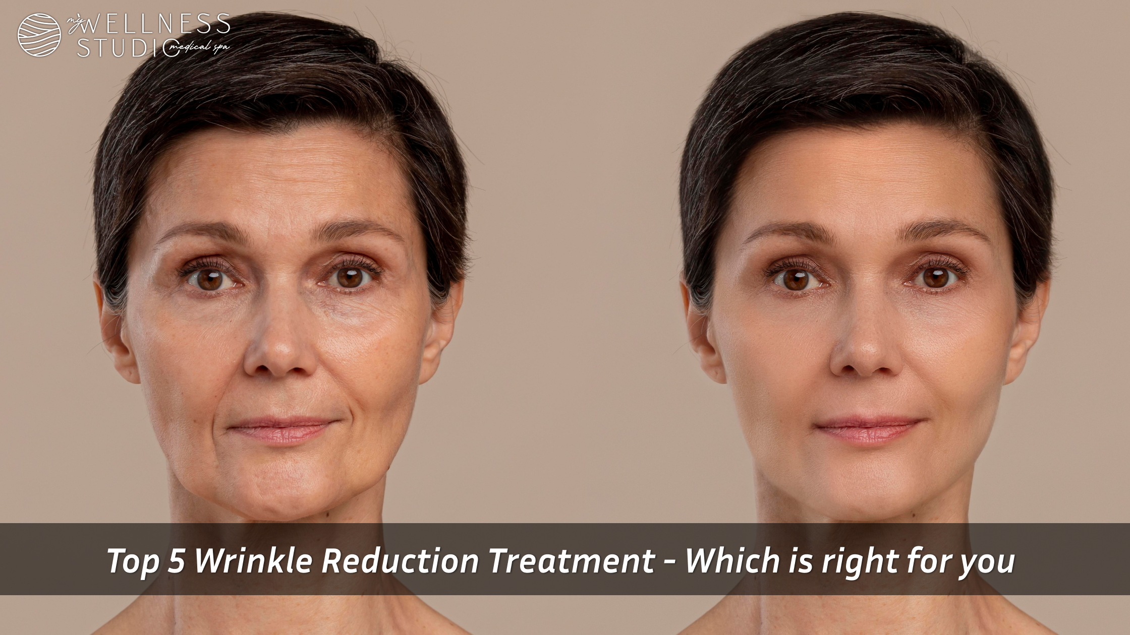 wrinkle reduction treatments