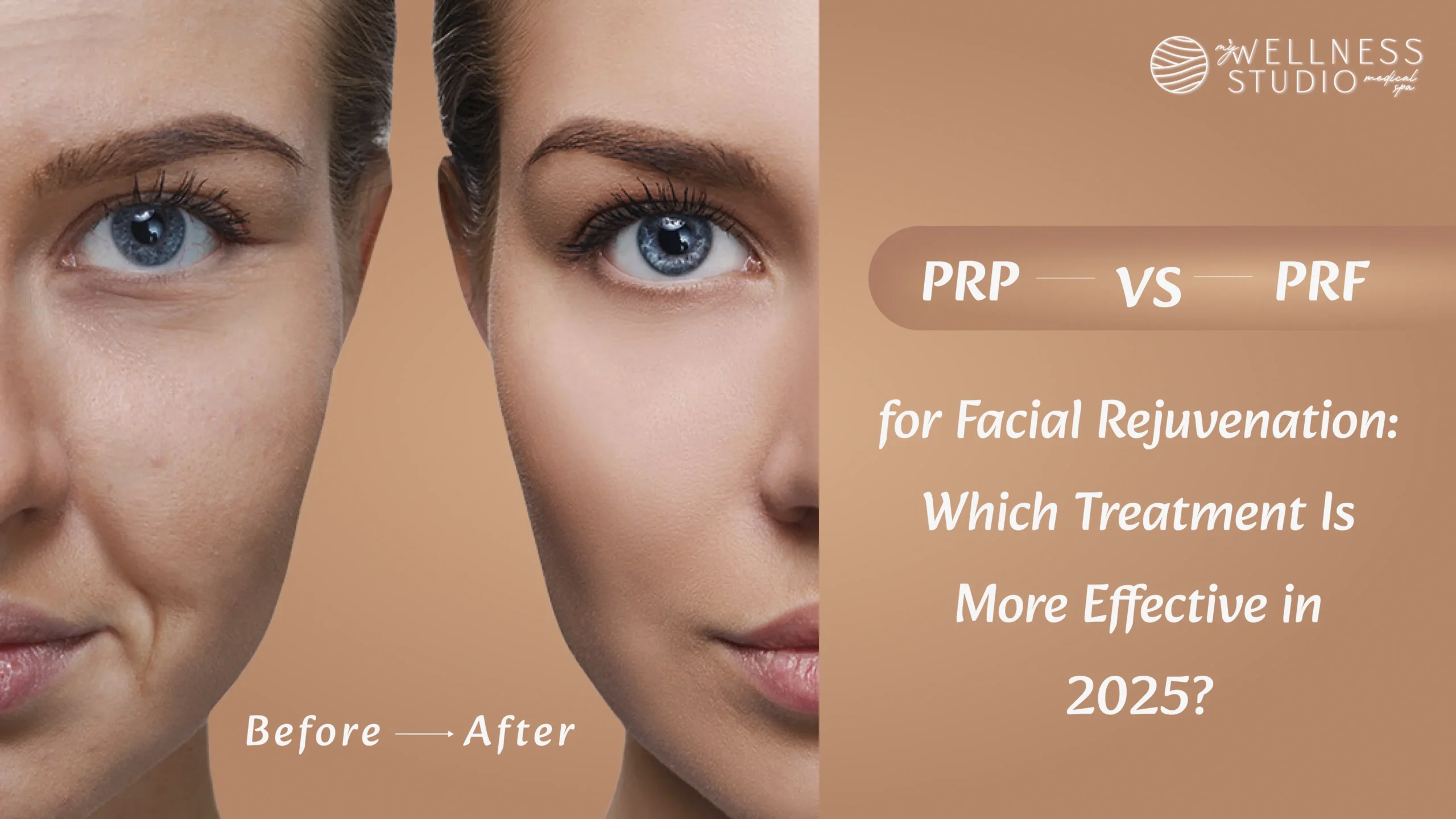 PRF vs PRP Facial Rejuvenation in 2025